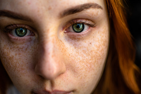 Beyond Beauty: Embracing Skin Imperfections - Confident Skin by Julie, West Ryde Beauty Clinic
