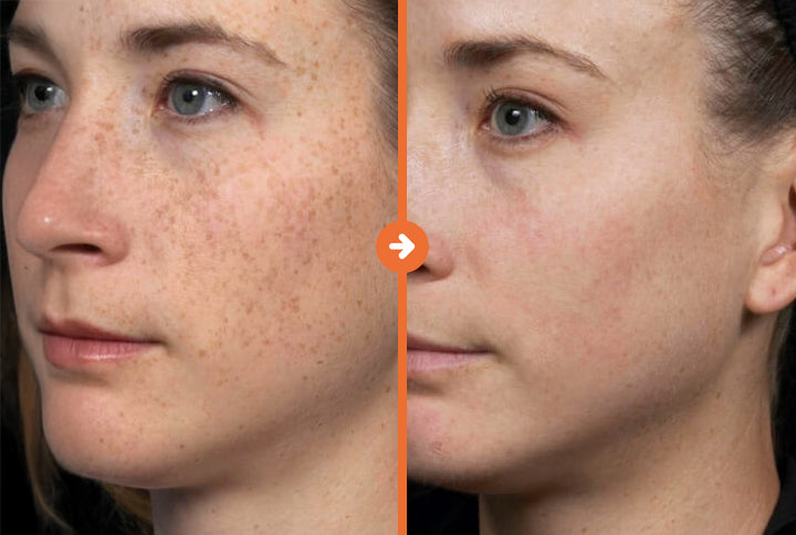 Medlite C6 Laser for Skin Rejuvenation - Confident Skin By Julie