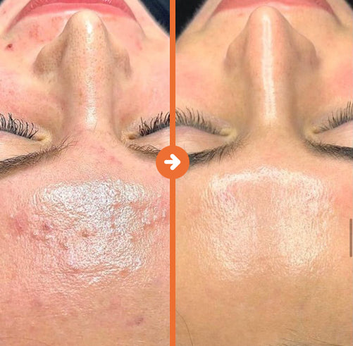 BioRepeel - Microneedling - Confident Skin By Julie