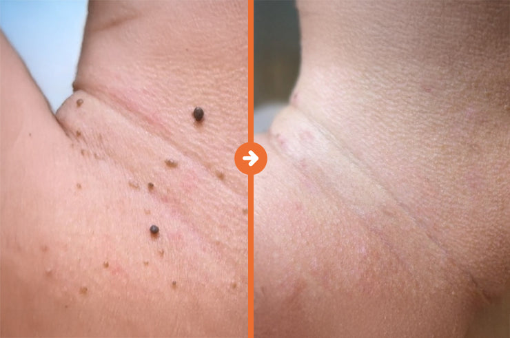 Skin Tags Bumps Removal - Confident Skin By Julie